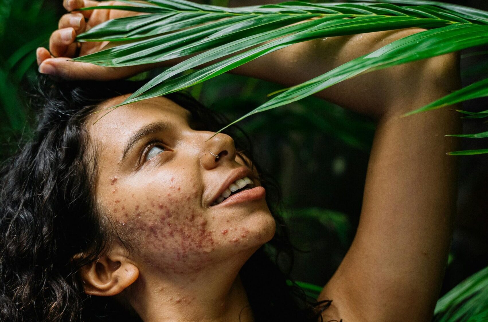 acne, acne treatment, types of acne, acne causes, hormonal acne, cystic acne, blackheads, whiteheads, acne prevention, acne remedies, acne scars, adult acne, acne-prone skin, skincare for acne, acne solutions, pimples, oily skin, acne products, acne medication, clear skin